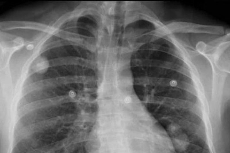 Nódulo pulmonar: qué significa el hallazgo que llevará al papa León XIV a cirugía